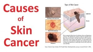 skin cancer pic