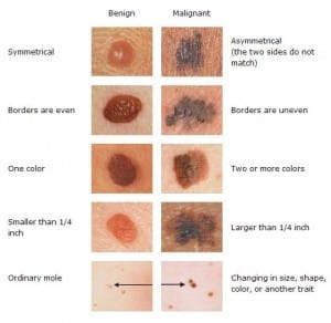 symptoms-of-skin-cancer-036ituwa