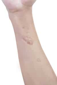 keloid scar