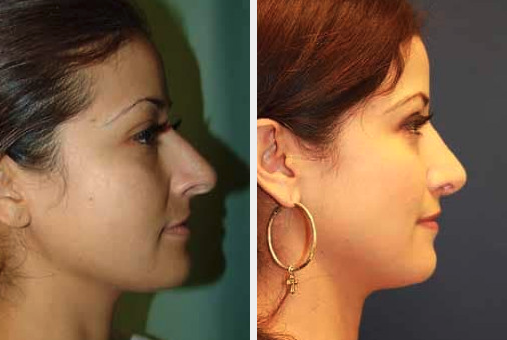 Rhinoplasty Female Side View