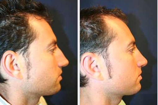 Rhinoplasty Side View