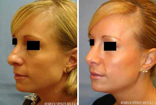 Nose Surgery