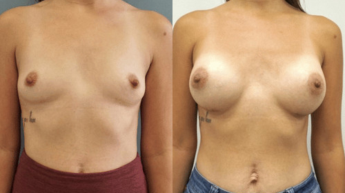 breast augmentation