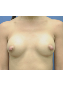 Breast Augmentation-Dr. Fernando Ovalle
