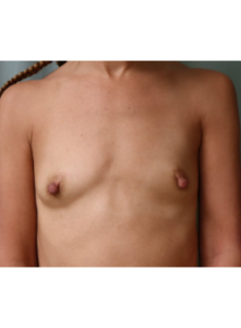 Breast Augmentation-Dr. Fernando Ovalle