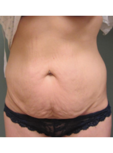 Lipoabdominoplasty-Dr. Fernando Ovalle