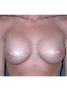 Breast Augmentation-Dr. Fernando Ovalle