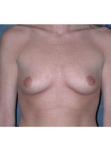 Breast Augmentation-Dr. Fernando Ovalle