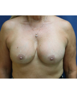 Breast Implant Revisions-Dr. Fernando Ovalle