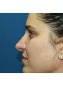 Nose Surgery-Dr. Kenrick Spence