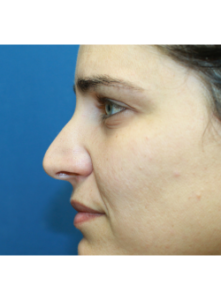 Nose Surgery-Dr. Kenrick Spence