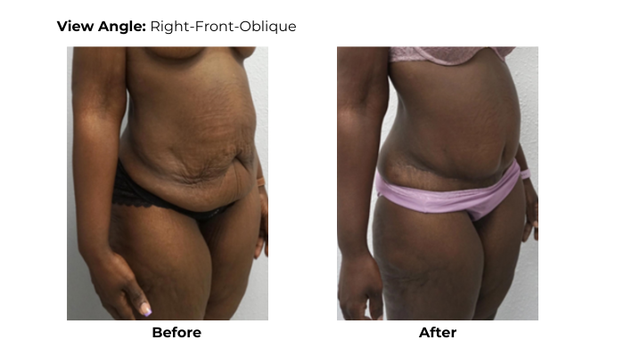 Weight Loss Loose Skin Removal