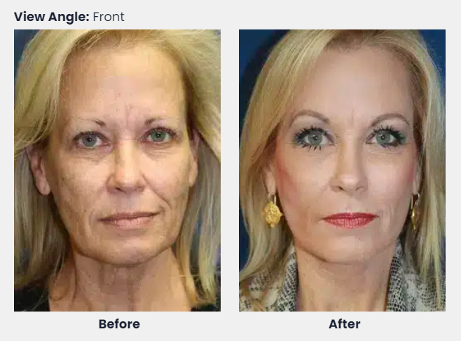 Ozempic Face skin tightening