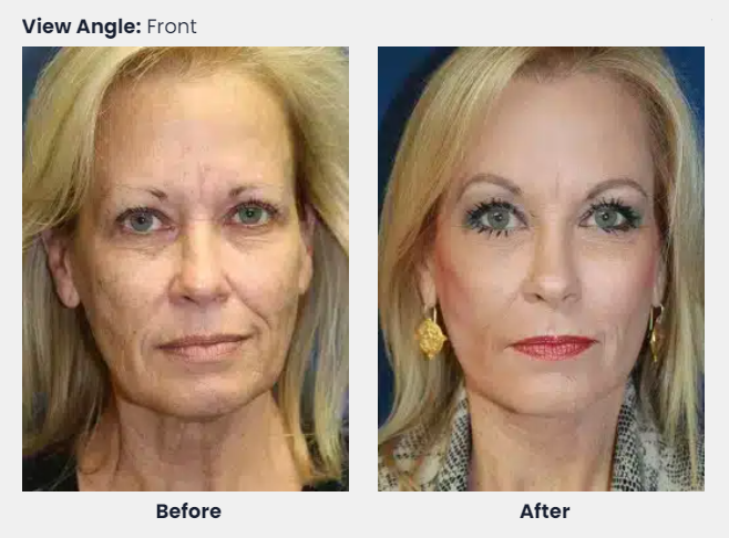 Jowls before And After Weight Loss 2024  : Transform Your Face Today