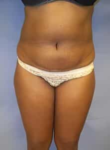 Abdominoplasty-Dr. Kenrick Spence