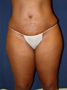 Abdominoplasty-Dr. Kenrick Spence