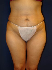 Abdominoplastia-Dr. Kenrick Spence