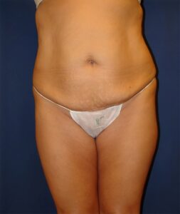 Abdominoplasty-Dr. Kenrick Spence