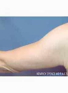 Brachioplasty-Dr. Kenrick Spence