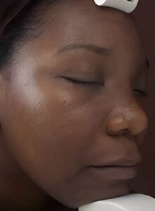 Chemical Peels-Dr. Kenrick Spence