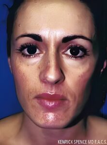 Chemical Peels-Dr. Kenrick Spence