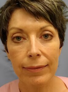 After Image: Injectable Fillers-Dr. Kenrick Spence