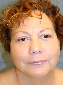 After Image: Injectable Fillers-Dr. Kenrick Spence