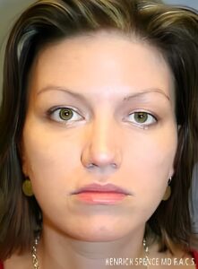 After Image: Injectable Fillers-Dr. Kenrick Spence
