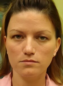 Before Image: Injectable Fillers-Dr. Kenrick Spence