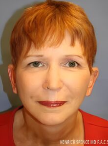 After Image: Injectable Fillers-Dr. Kenrick Spence