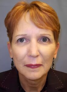Before Image: Injectable Fillers-Dr. Kenrick Spence