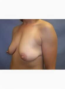 Breast Lift-Dr. Kenrick Spence