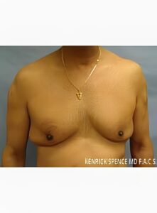 Gynecomastia-Dr. Kenrick Spence