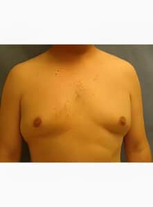 Gynecomastia-Dr. Kenrick Spence