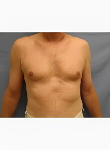 Gynecomastia-Dr. Kenrick Spence