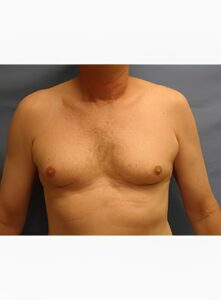 Gynecomastia-Dr. Kenrick Spence