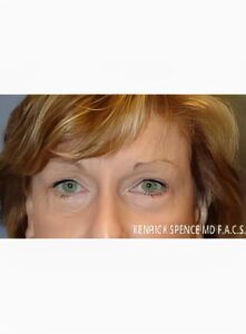 Brow Lift & Eyelid Surgery-Dr. Kenrick Spence