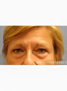 Levantamiento de cejas y cirugía de párpados-Dr. Kenrick Spence