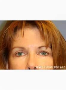 Brow Lift & Eyelid Surgery-Dr. Kenrick Spence