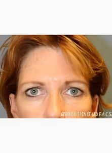 Brow Lift & Eyelid Surgery-Dr. Kenrick Spence