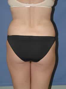 Fat Grafting Buttocks-Dr. Kenrick Spence