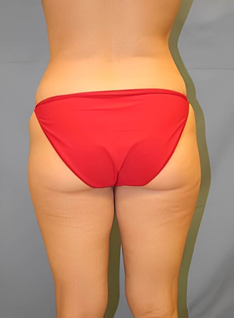 Before Image: Liposuction Back-Dr. Kenrick Spence - back