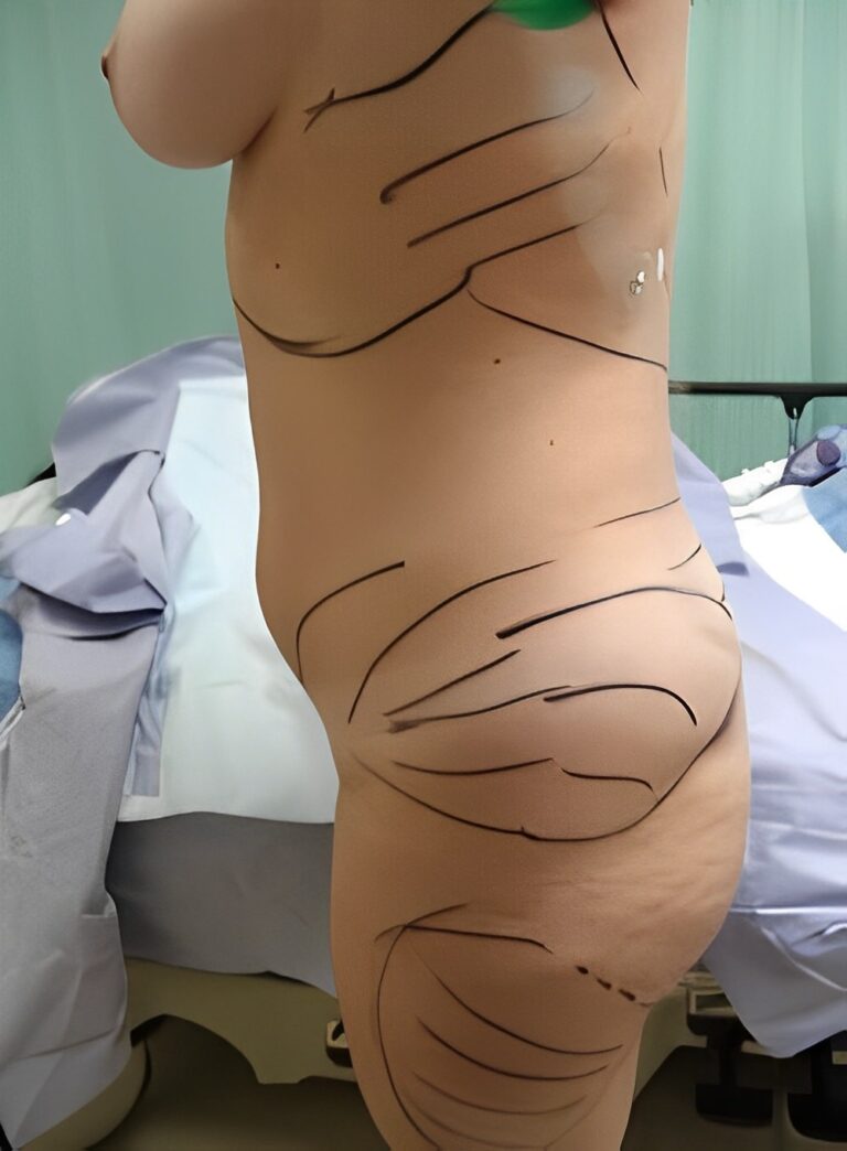 Before Image: Liposuction Back-Dr. Kenrick Spence - left-side