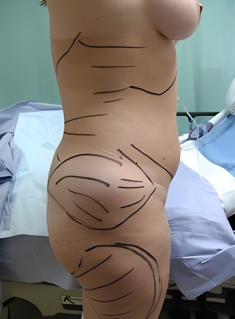 Before Image: Liposuction Back-Dr. Kenrick Spence - front