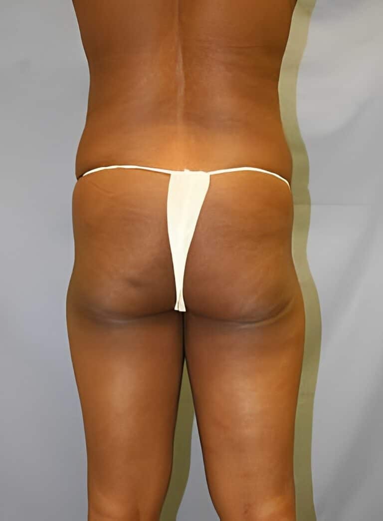 After Image: Liposuction Back-Dr. Kenrick Spence - back