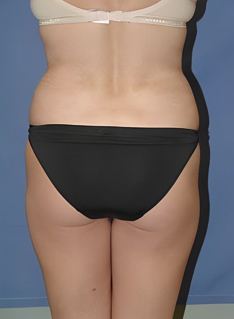Before Image: Liposuction Back-Dr. Kenrick Spence - back