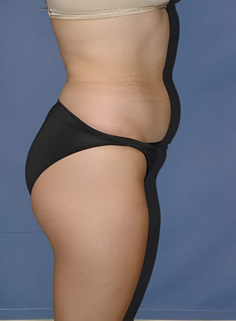 Before Image: Liposuction Back-Dr. Kenrick Spence - right-side