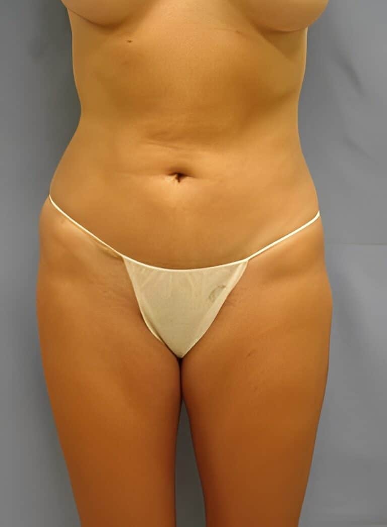 After Image: Liposuction Back-Dr. Kenrick Spence - front