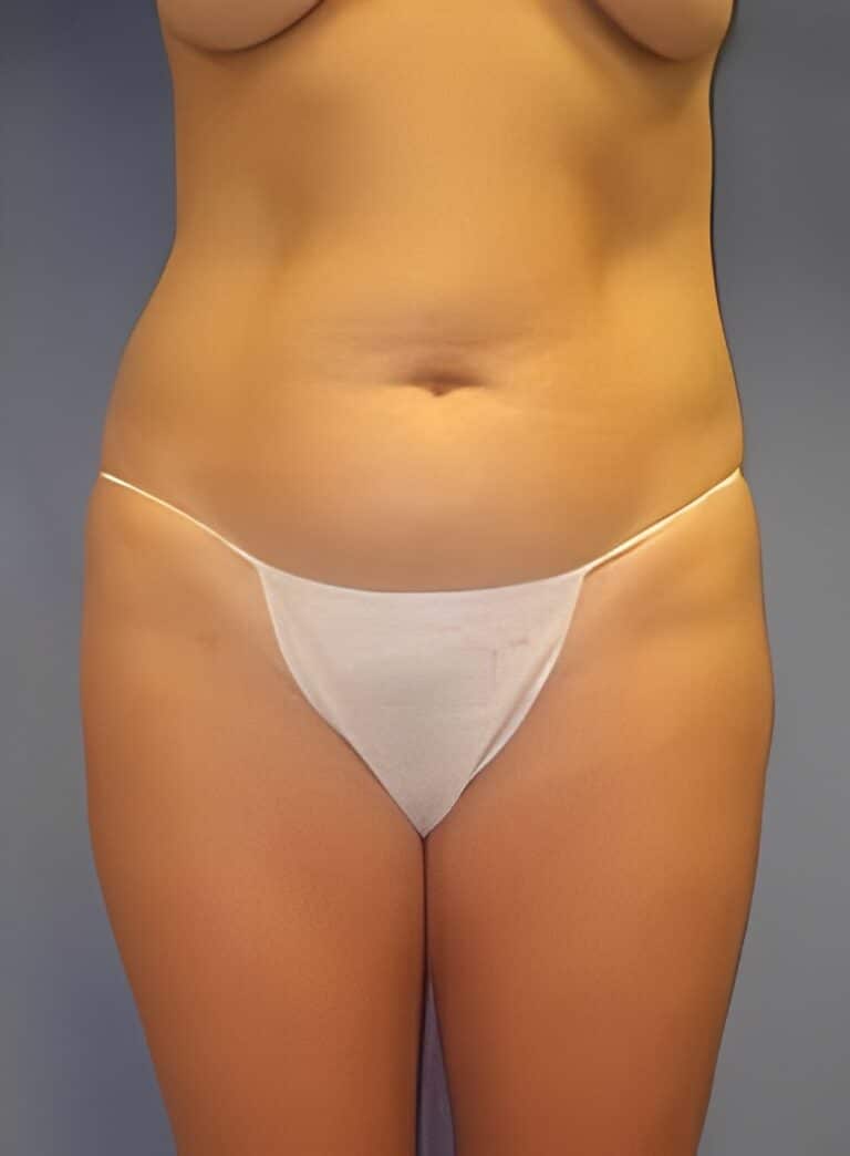 Before Image: Liposuction Back-Dr. Kenrick Spence - front