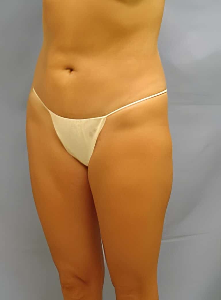 After Image: Liposuction Back-Dr. Kenrick Spence - left-front-oblique